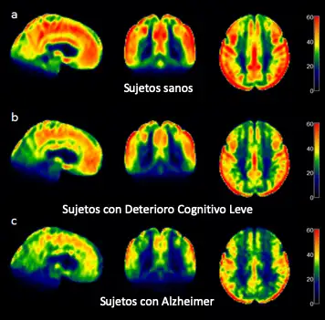 img-disminucion-perfusion-cerebral