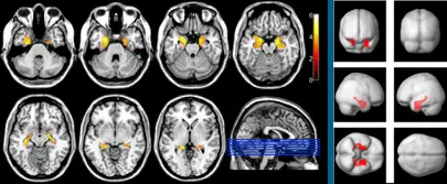 img-regiones-atrofia-enfermedad-alzheimer