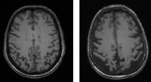 img-resonancia-enfermedad-alzheimer
