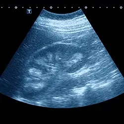 img-destacado-ecografia-renal