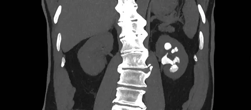 img-destacado-tac-litiasis-renal