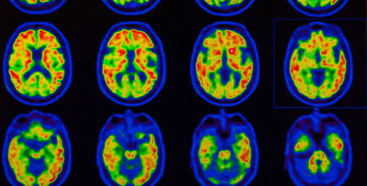 PET Alzheimer. Clínica Universidad de Navarra