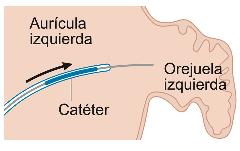 Introducción del catéter para el cierre de orejuela