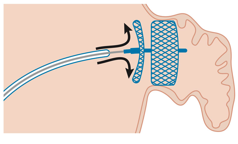 Colocación del dispositivo del cierre de orejuela