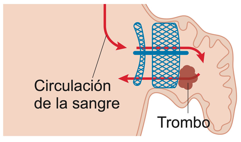 Funcionamiento del cierre de la orejuela