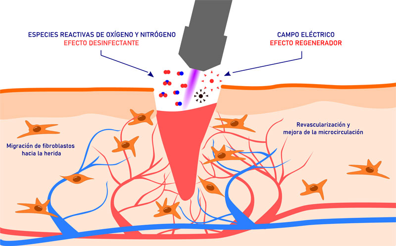 Infografía plasma en úlceras venosas vasculares
