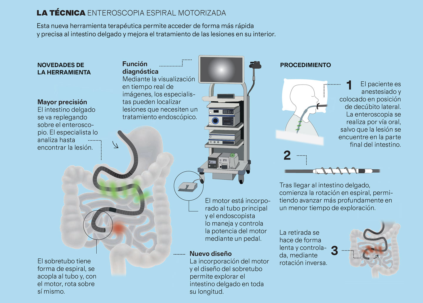 Infografía enteroscopia digital motorizada