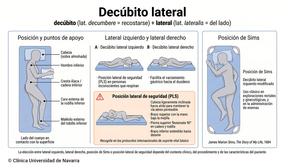 Esquema del decúbito lateral en medicina: posición del paciente con sus puntos de apoyo (cabeza, hombro, cresta ilíaca, rodilla y maléolo externo), comparación entre decúbito lateral izquierdo y derecho con sus indicaciones clínicas, posición lateral de seguridad (PLS) con su técnica y la posición de Sims como variante histórica para exploraciones rectales y ginecológicas.