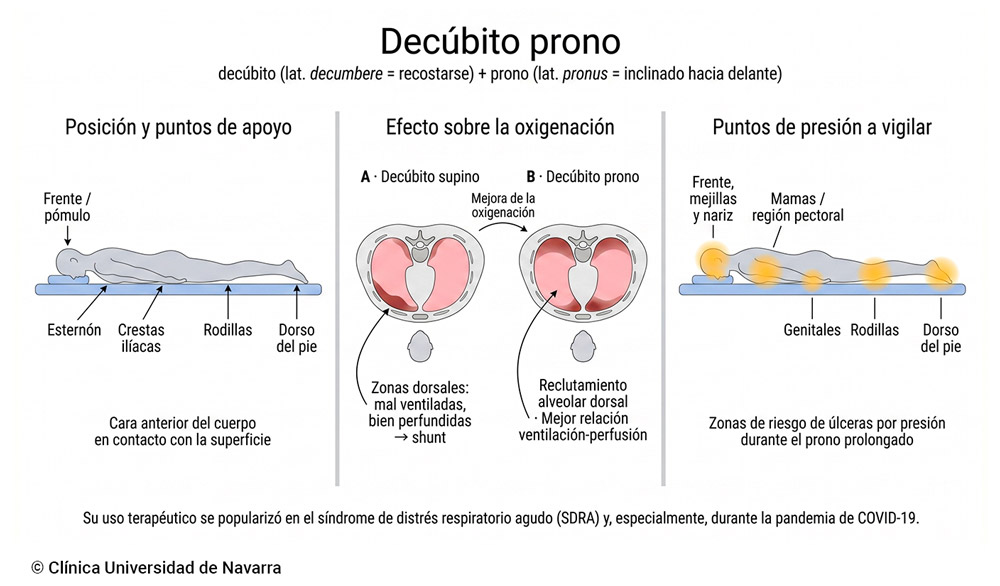 Esquema del decúbito prono como maniobra terapéutica: posición del paciente con sus cinco puntos de apoyo (frente, esternón, crestas ilíacas, rodillas y dorso del pie), efecto sobre la oxigenación pulmonar mediante reclutamiento alveolar dorsal en cortes axiales del tórax comparados con el decúbito supino, y zonas de riesgo de úlceras por presión durante el prono prolongado.