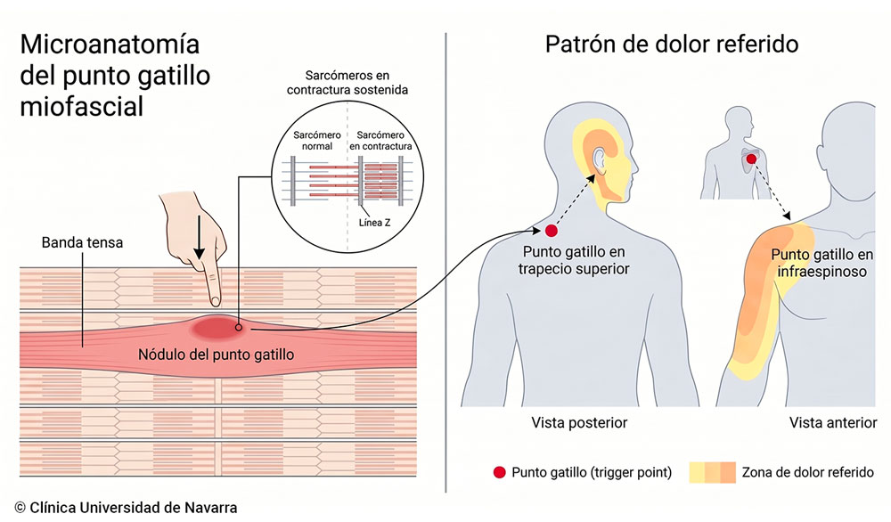 Esquema del punto gatillo miofascial: microanatomía de la banda tensa muscular con el nódulo hiperirritable y los sarcómeros en contractura sostenida, junto al patrón clásico de dolor referido a distancia desde dos puntos gatillo característicos (trapecio superior con dolor referido a la cabeza, infraespinoso con dolor referido al hombro anterior y brazo).