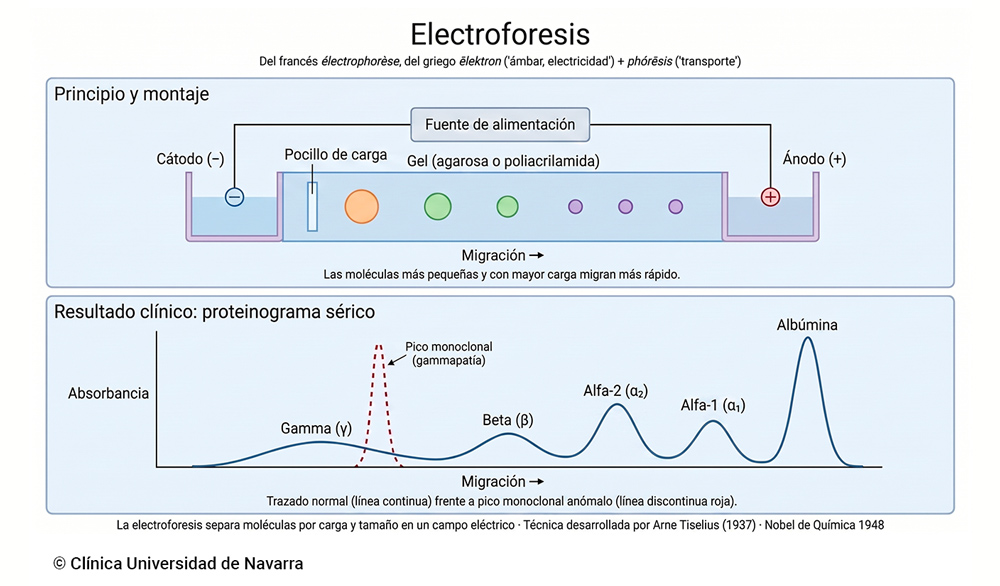 Esquema del principio de la electroforesis con montaje de cubeta, electrodos cátodo y ánodo, gel de soporte y moléculas migrando según carga y tamaño, junto al trazado densitométrico del proteinograma sérico con las cinco fracciones (albúmina, alfa-1, alfa-2, beta y gamma) y un pico monoclonal anómalo superpuesto.