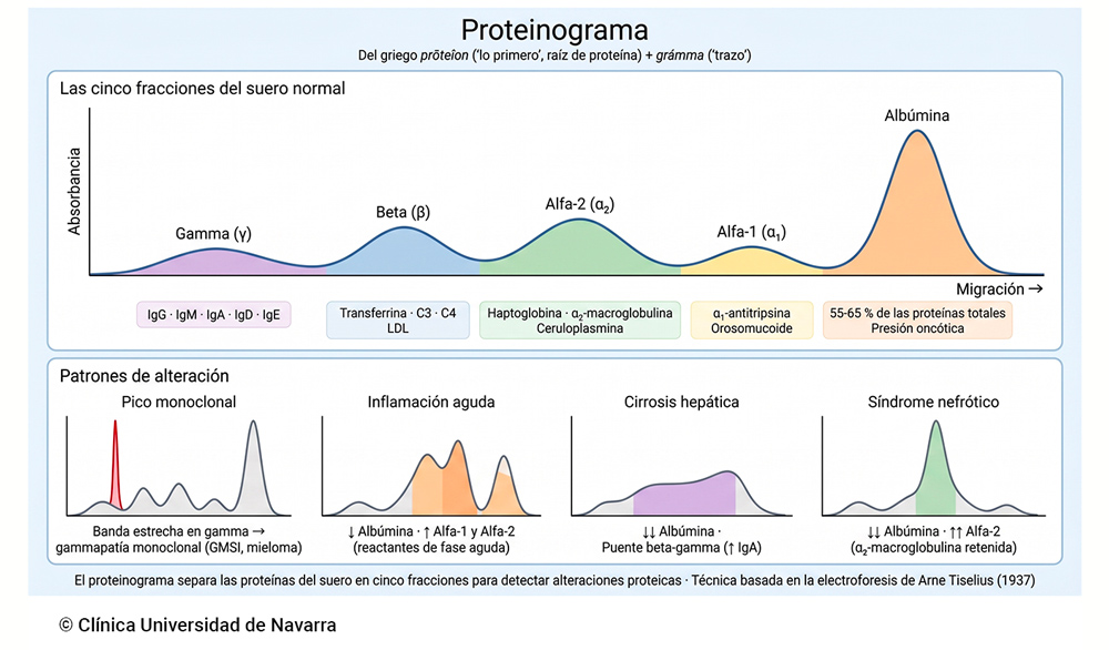 Trazado densitométrico del proteinograma sérico normal con las cinco fracciones proteicas (albúmina, alfa-1, alfa-2, beta y gammaglobulinas) coloreadas e identificadas con sus proteínas principales, junto a cuatro patrones de alteración frecuentes: pico monoclonal, inflamación aguda, cirrosis hepática con puente beta-gamma y síndrome nefrótico.