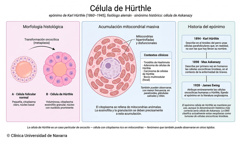 Esquema de la célula de Hürthle: morfología histológica comparada con la célula folicular tiroidea normal (mayor tamaño, citoplasma eosinófilo granular y nucléolo prominente), explicación subcelular del fenómeno por acumulación masiva de mitocondrias hipertrofiadas en el citoplasma, contextos clínicos donde se observa (tiroiditis de Hashimoto, adenoma y carcinoma de células de Hürthle, bocio multinodular) y línea de tiempo del epónimo desde la descripción original en perros por Hürthle (1894) hasta la atribución errónea de Ewing (1928).