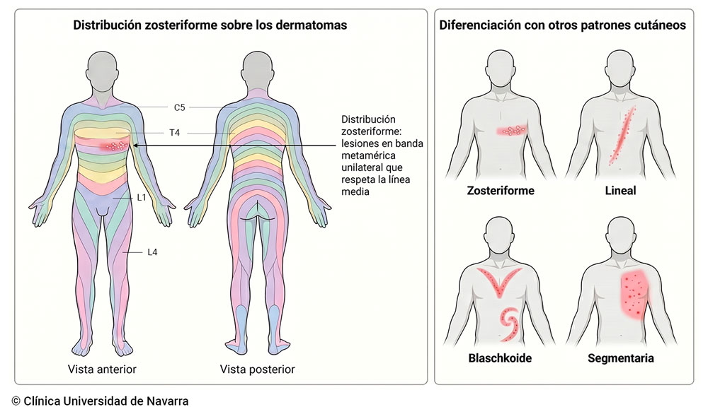 Esquema de la distribución zosteriforme cutánea sobre el mapa de dermatomas, con una erupción vesicular agrupada en banda metamérica unilateral que respeta la línea media (patrón típico del herpes zóster), junto a un panel comparativo con los otros patrones dermatológicos relacionados: lineal, blaschkoide y segmentario.