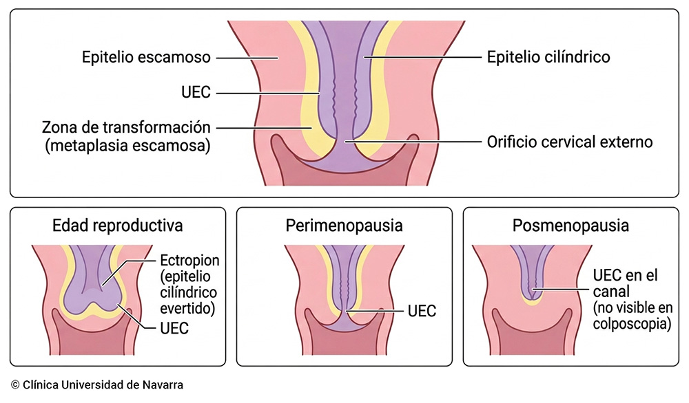 Corte anatómico del cuello uterino con la unión escamocolumnar y la zona de transformación señaladas, donde se origina la mayoría de las lesiones precancerosas y cerca del 90 % de los cánceres de cérvix; tres esquemas comparativos muestran su desplazamiento desde el exocérvix en la edad reproductiva hasta el canal endocervical en la postmenopausia.