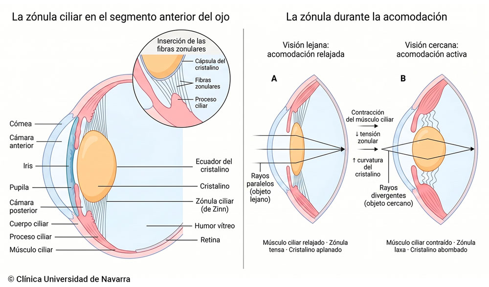 Esquema de la zónula ciliar (de Zinn) en el segmento anterior del ojo, con detalle de la inserción de las fibras zonulares en el ecuador del cristalino, y comparación de su comportamiento durante la acomodación: fibras tensas y cristalino aplanado en visión lejana frente a fibras laxas y cristalino abombado en visión cercana.