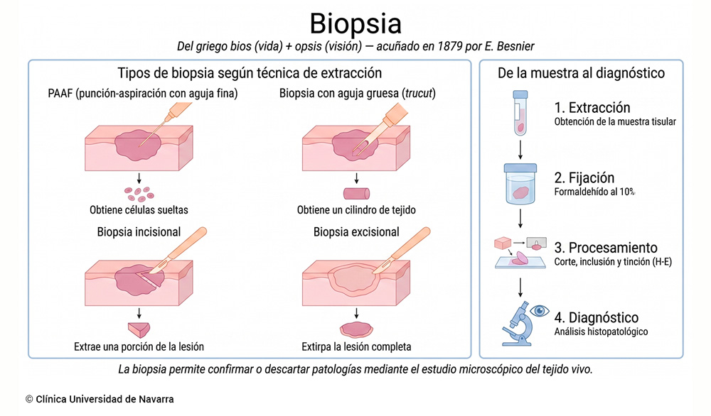 Esquema comparativo de los cuatro tipos principales de biopsia según su técnica de extracción (PAAF, aguja gruesa o trucut, incisional y excisional).