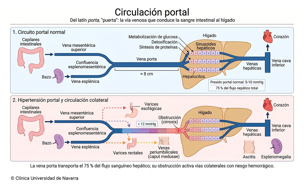Esquema del circuito de la circulación portal que muestra el recorrido de la sangre venosa desde los capilares intestinales y el bazo, a través de la vena porta, hasta los sinusoides hepáticos y la vena cava inferior (presión normal 5-10 mmHg, 75 % del flujo hepático), junto con las vías colaterales que se activan en la hipertensión portal: varices esofágicas, varices rectales y venas periumbilicales.