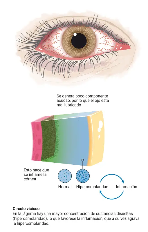 Tipo de ojo seco. Acuodeficiente. Clínica Universidad de Navarra Infografía sobre el tipo de ojo seco acuodeficiente, el que tiene una disminución en la producción de lágrimas acuosas.