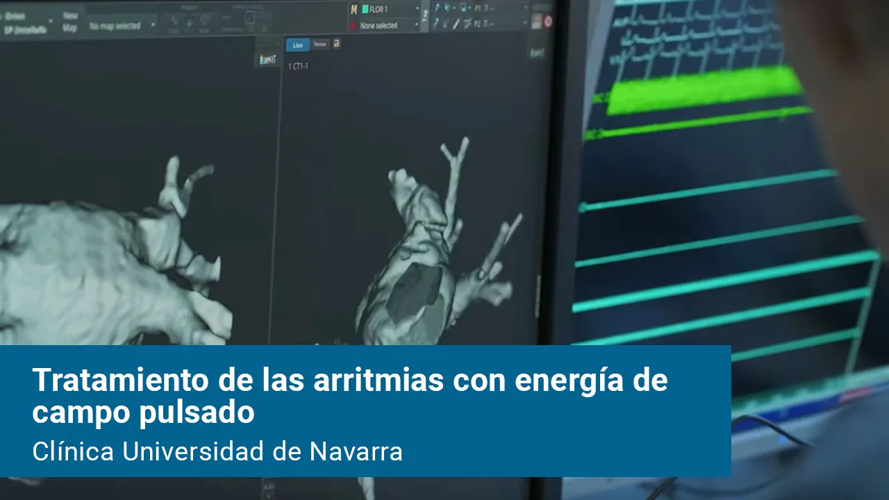Vídeo sobre este novedoso procedimiento realiza el tratamiento en las células cardíacas a través de campos eléctricos, lo que permite una mayor precisión de los procedimientos de ablación, que se llevan a cabo con mayor rapidez, comodidad y seguridad para el paciente y una elevada tasa de éxito.