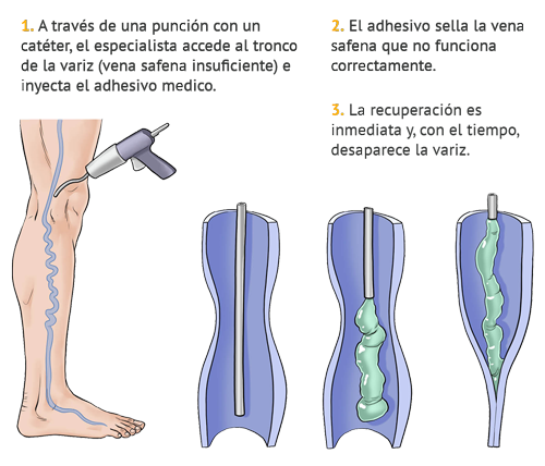 chequeo de venas varicosas